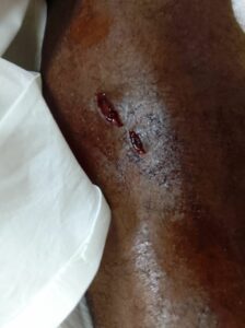 Snake bite marks on man's calf.