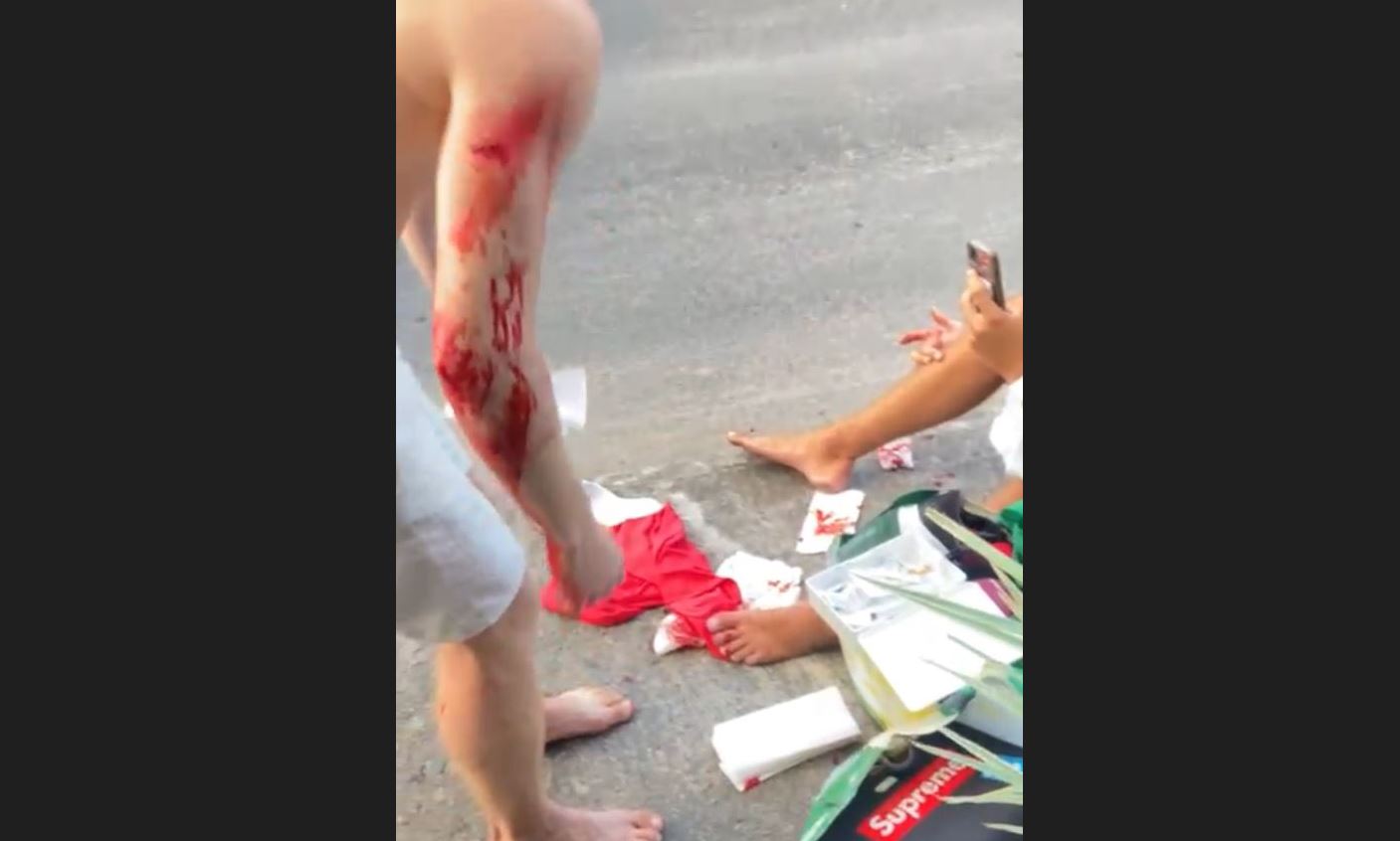 Bleeding pedestrians, one standing and one sitting on the ground, after a vehicle hit them at Rodney Bay.