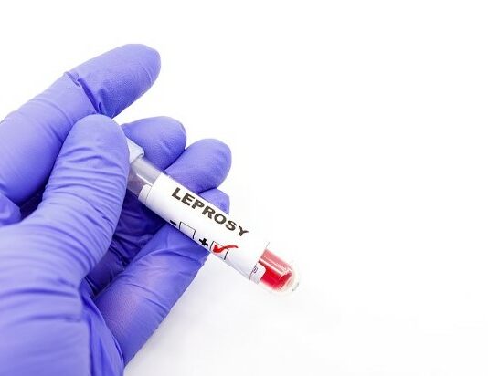 Test tube with blood and label indicating positive leprosy diagnosis.