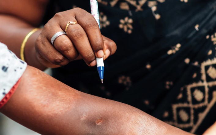 Women using pen to point to a leprosy spot on someone's arm.