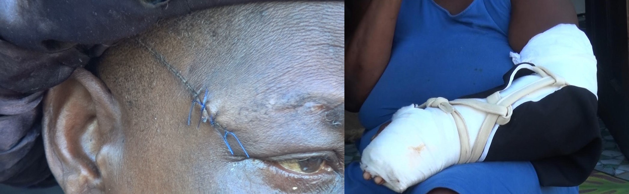 Photo collage of stitches and bandaged arm of Choiseul chopping victim.