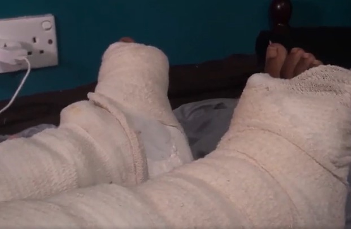 Injured student on hospital bed with legs in cast.