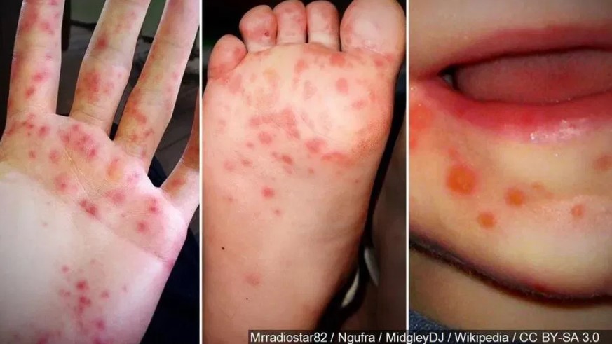 Hand, foot & mouth disease.