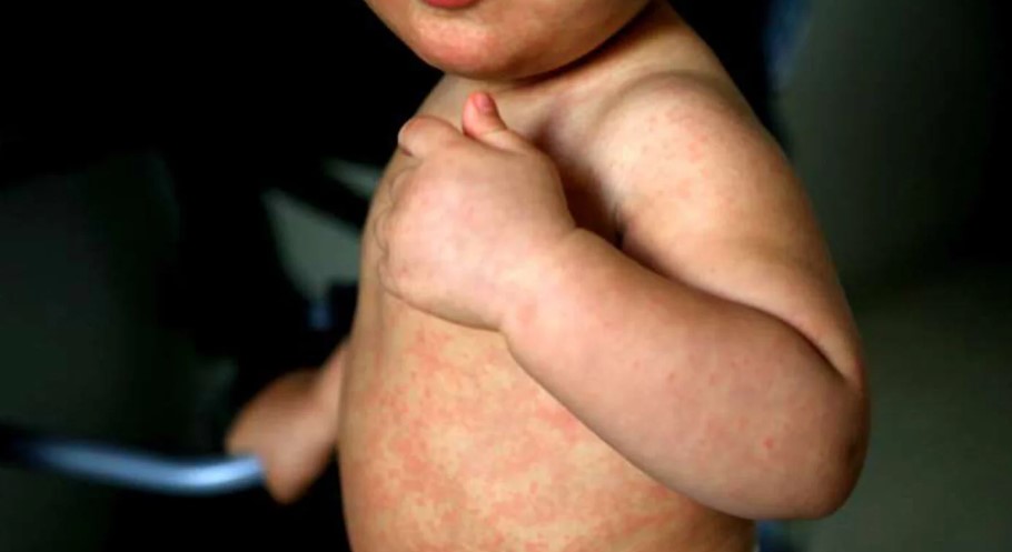 Child with measles.