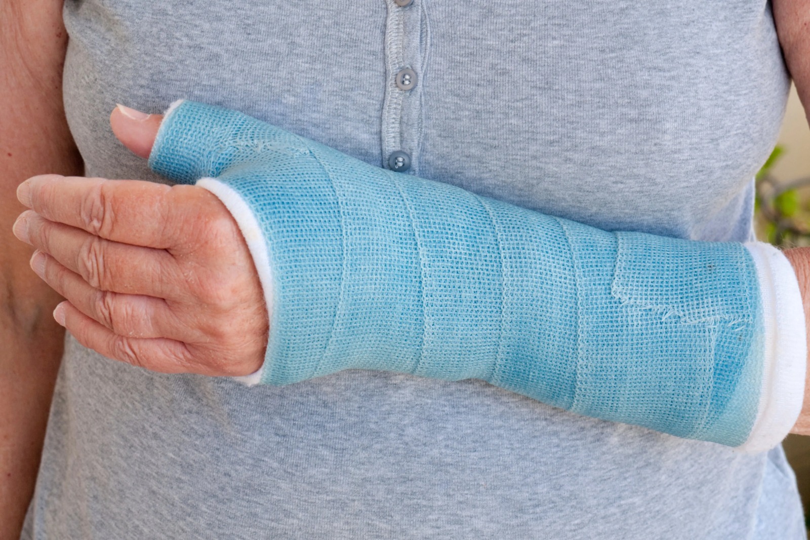 China creates ‘bone glue’ that will mend breaks in minutes